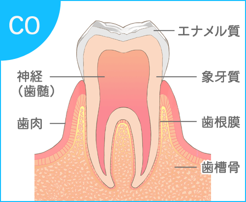 むし歯の進行過程