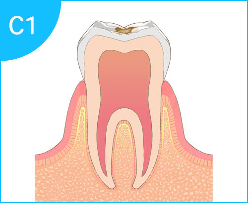 むし歯の進行過程