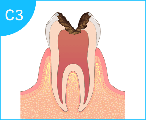 むし歯の進行過程