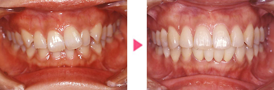 矯正症例
